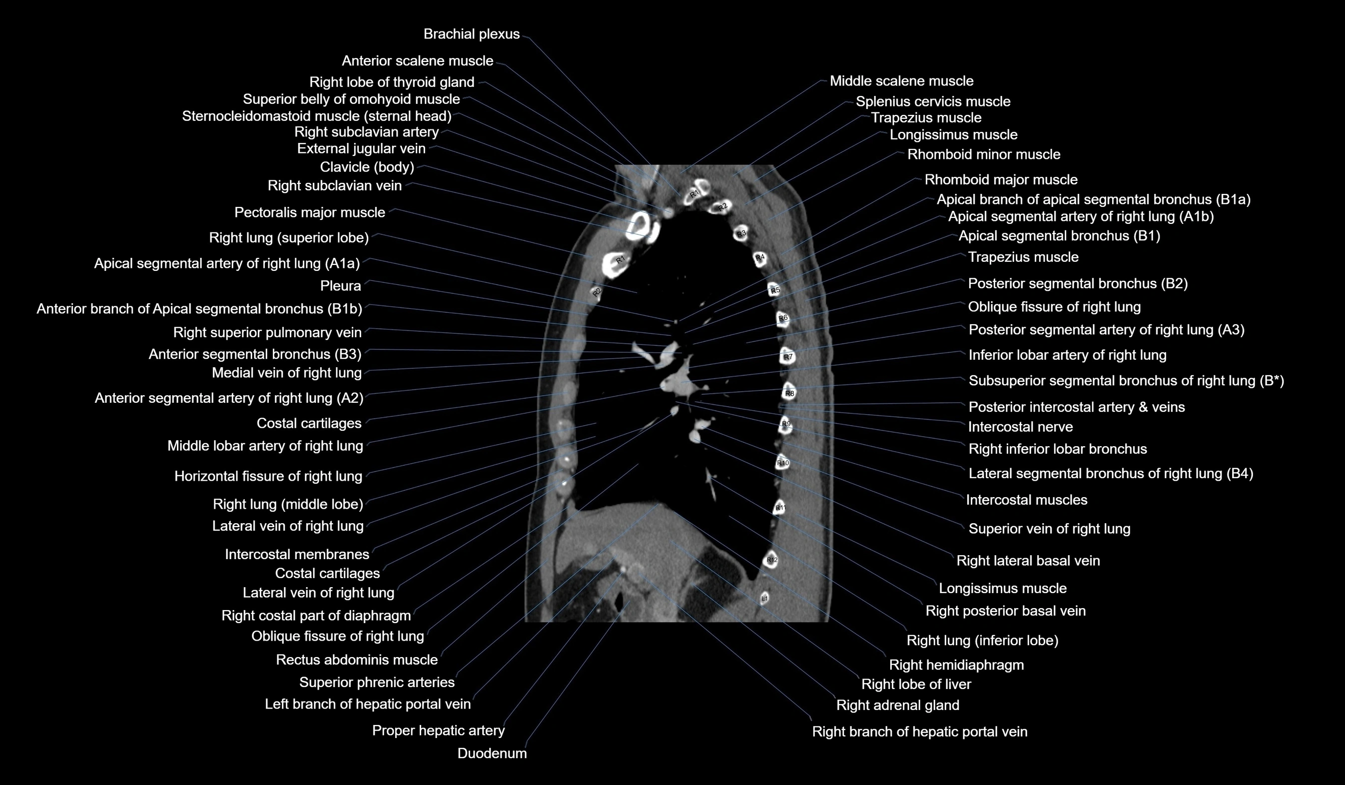 CT chest (thorax) soft tissue window labelled sagittal cross sectional anatomy radiology image-00057.webp